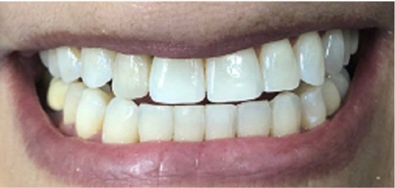 After whitening treatment at Bhati Dental Clinic
